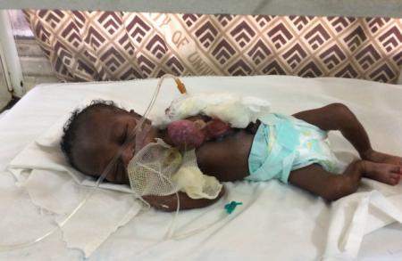 Baby-born-with-heart-outside-received-cash-donations-on-HWN-HUMANITY