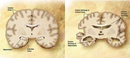 Alzheimers-Disease,-Leaky-blood-brain-barrier-Indicted-on-HWN-INSIGHTS