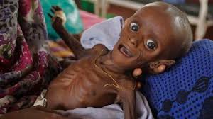 Malnutrition-maims-over-one-thousand-Nigerian-children-daily-on-HWN-HIGHLIGHT