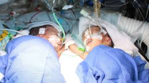 World-First-Youngest-Conjoined-Twins-Separated-on-HWN-EXTREMES