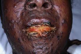 Killer-Disease-(Stephen-Johnson-Syndrome)-Hits-Nigeria-on-HWN-SJS-UPDATE