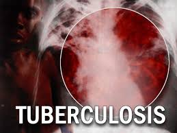 Drug-resistant-tuberculosis-end-game-on-HWN-INSIGHTS