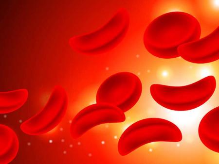 French-teenager-sickle-cell-disease-reversed-on-HWN-SICKLE-CELL-DISEASE