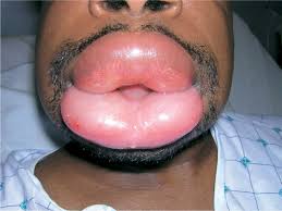 Lisinopril-Causing-Angioedema-Among-African-Americans-on-HWN-SAFETY